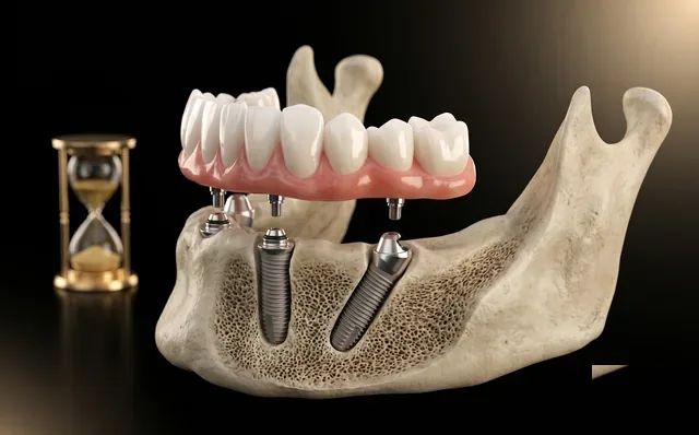Carga imediata - dentes fixos em poucos dias